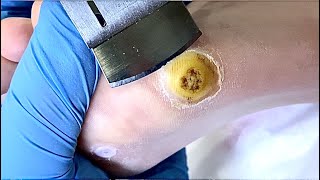 Pedicure tutorial careful removal of viral wartampwarts treatment【foot care】 [upl. by Aninaig]