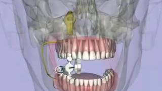 Long Buccal Nerve BlockBuccal Nerve Block [upl. by Einimod]