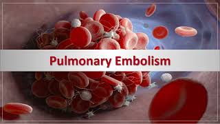 Pulmonary Embolism  الانصمام الرئوي [upl. by Crandall]