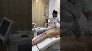 Renas  Fractional Erbium Glass Laser for Stretch Marks Treatment [upl. by Ettenawtna528]