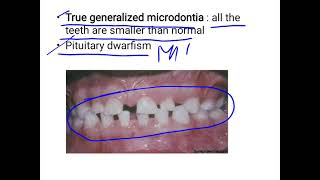Microdontia [upl. by Rapsag116]