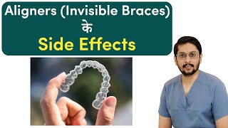 Aligners Invisible Braces के Side Effects  Dr Ankit  Seraphic Dental Indore [upl. by Noivad]