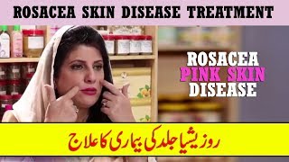 Rosacea Skin Disease Treatment by Dr Bilquis Shaikh  Rosacea Gulabi Skin Disease [upl. by Lambert]