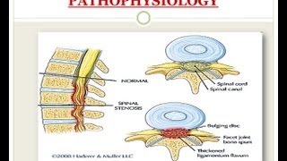 Spinal Stenosis  Medical PowerPoint Presentation [upl. by Tizes]