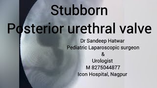 Posterior urethral valve fulguration [upl. by Madai175]