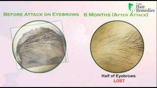 Eyebrows Alopecia Areata [upl. by Nollid]