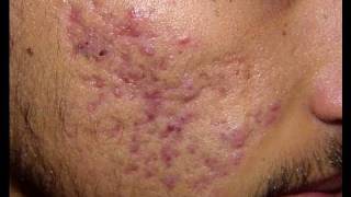 DermTV  Debunking Acnes Greatest Myths DermTVCom Epi 023 [upl. by Arot]