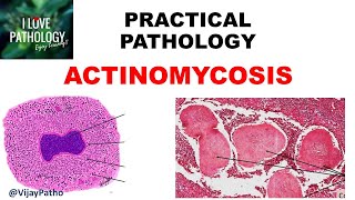 Practical Pathology ACTINOMYCOSIS [upl. by Noyart]