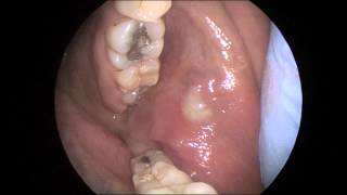 Acute Parotitis in HD [upl. by Eelrebmik]