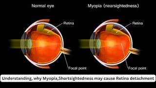 eyeoptometrist Understanding why MyopiaShortsightedness may cause Retina detachment [upl. by Inalaehon564]