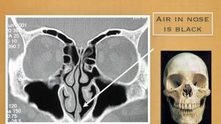 Allergic Fungal Sinusitis Moviemov [upl. by Nediarb]