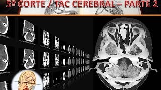 TAC Cerebral 5to corte parte 2 [upl. by Aikym]