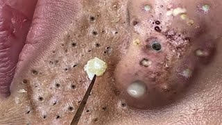 massive blackheads on nose and lips  Blackhead Removal With Sac Dep Spa 2024 [upl. by Nich]