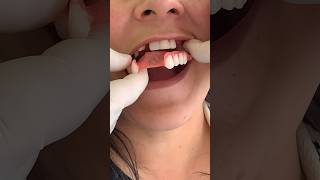 Flexible dental prosthesis does it work in the mouth music love travel viral dentist mrdent [upl. by Windham]