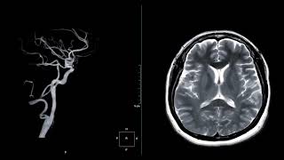 Vascularização cerebral  Artérias cerebrais  Neuroimagem neuroexplica fonoaudiologia [upl. by Dagnah]