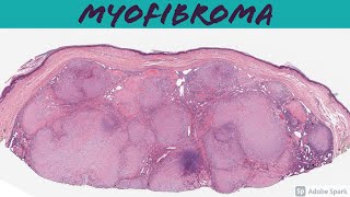 Myofibroma amp Myofibromatosis 101 [upl. by Esened680]