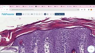 PITYRIASIS ROSEA Psoriasis clear cell acanthoma Lichen planus BLK LICHEN SCLEROSUS [upl. by Ellenrad]