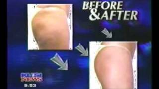 The Wellbox Cellulite Reduction [upl. by Anailli963]