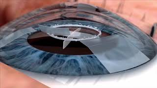 Watch live surgery using the laser cataract system  how does it work Eye News TV [upl. by Adnarom]