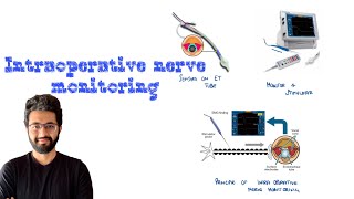 Intraoperative Neuromonitoring  IONM [upl. by Hitchcock]