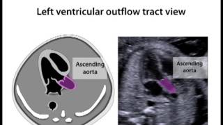 Left Ventricular Outflow Tract View 119 [upl. by Aubarta]