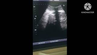 Hydronephrosis with hydroureter  Ultrasound stone in proximal ureter twinkling artifact CDPD [upl. by Hamil]