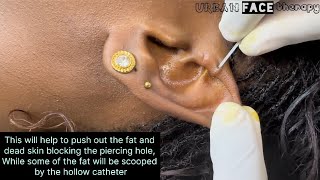 Reopening a blocked piercing No needle used earpiercing [upl. by Ahsemac170]