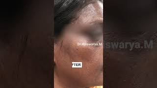 Pigmentation Treatment on Face  Before amp After sikhiskinclinic shorts ytshorts pigmentation [upl. by Belloir]