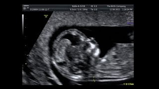 Nuchal Translucency Scan 11 Weeks  14 Weeks [upl. by Priestley]