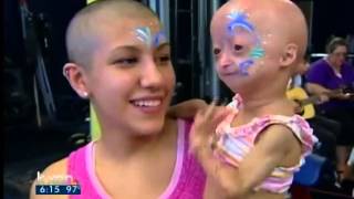 Adalia Rose holds fundraiser for Progeria [upl. by Connell]