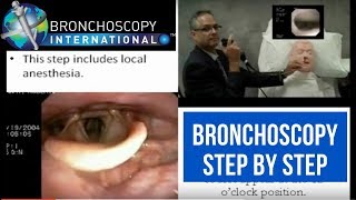 Bronchoscopy Step by Step Walkthrough 16 [upl. by Bebe]