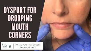 Dysport Injections to DAO Muscle for Drooping Mouth Corners [upl. by Keraj]