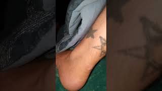 nocardia farcinica infection on my achilles Tennant getting better a month later [upl. by Airetas]