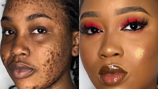 HOW TO COVER ACNE DARK SPOTS MARKS amp HYPERPIGMENTATION  FOUNDATION ROUTINE for hyperpigmentation [upl. by Mintun295]