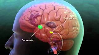 Deep Brain Stimulation explanation [upl. by Hoy]