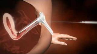 3D animation of how IUI works [upl. by Dietz]