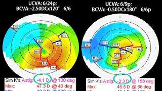 CAIRS A new technique for Keratoconus and corneal ecstasias [upl. by Adur]