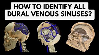 Dural venous sinuses  Identification in a 3D Model amp Cadaveric Specimen  Head Neck Anatomy [upl. by Maud]