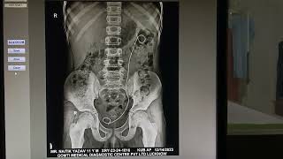 KUB x ray  Stent left side kub  kidney Ureters Bladder x ray kidney kub ureter bladder xray [upl. by Ueihtam]