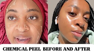 CHEMICAL PEEL FULL PROCESS BEFORE amp AFTER  HYPERPIGMENTATIONACNE ON BLACK SKIN  THE PERFECT PEEL [upl. by Toft371]