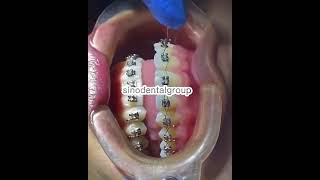 How to put braces ligature wire Sino Dental Group [upl. by Marlie829]