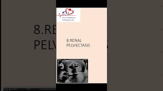 Renal pelviectasis on antenatal scanwhat should we do renalpelviectasis [upl. by Erme]