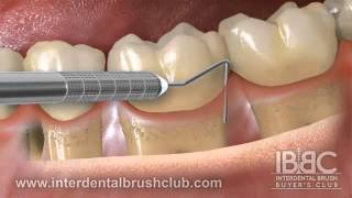 Periodontal disease causes and treatment [upl. by Gratia877]