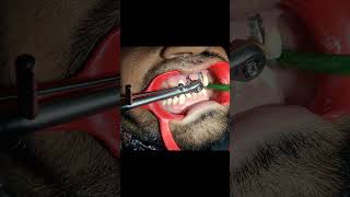 Dental Implant procedure dentist indiandentist dentistry [upl. by Lin174]