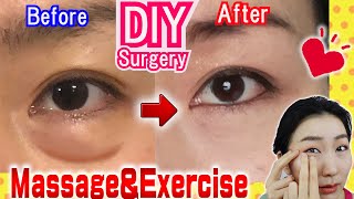 How to Remove Under Eye Bags👁️ Naturally in 7 Days Massage amp Exercises🙋 [upl. by Leiand157]