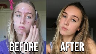 FROM SPOT TO HOT My Acne Story [upl. by Eirelav249]