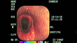 Laryngeal Hemiplegia Explained m4v [upl. by Silrac]