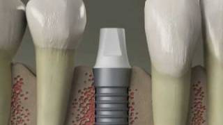 Dental Implants  Replace Missing Teeth  Procedure in Denville NJ [upl. by Adnovay]