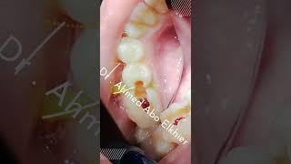 Single Visit Endodontic Treatment الكربولة endodontics dental [upl. by Ellenar226]