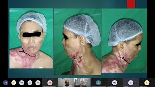 Plastiquest Case Discussion  PBC Neck [upl. by Winsor]